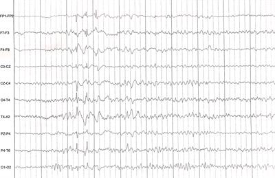 Case Report: Autoimmune Psychosis in Chromosome 22q11.2 Deletion Syndrome